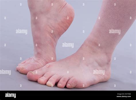 ugly feet pics|375 Images Of Ugly Feet Stock Photos & High